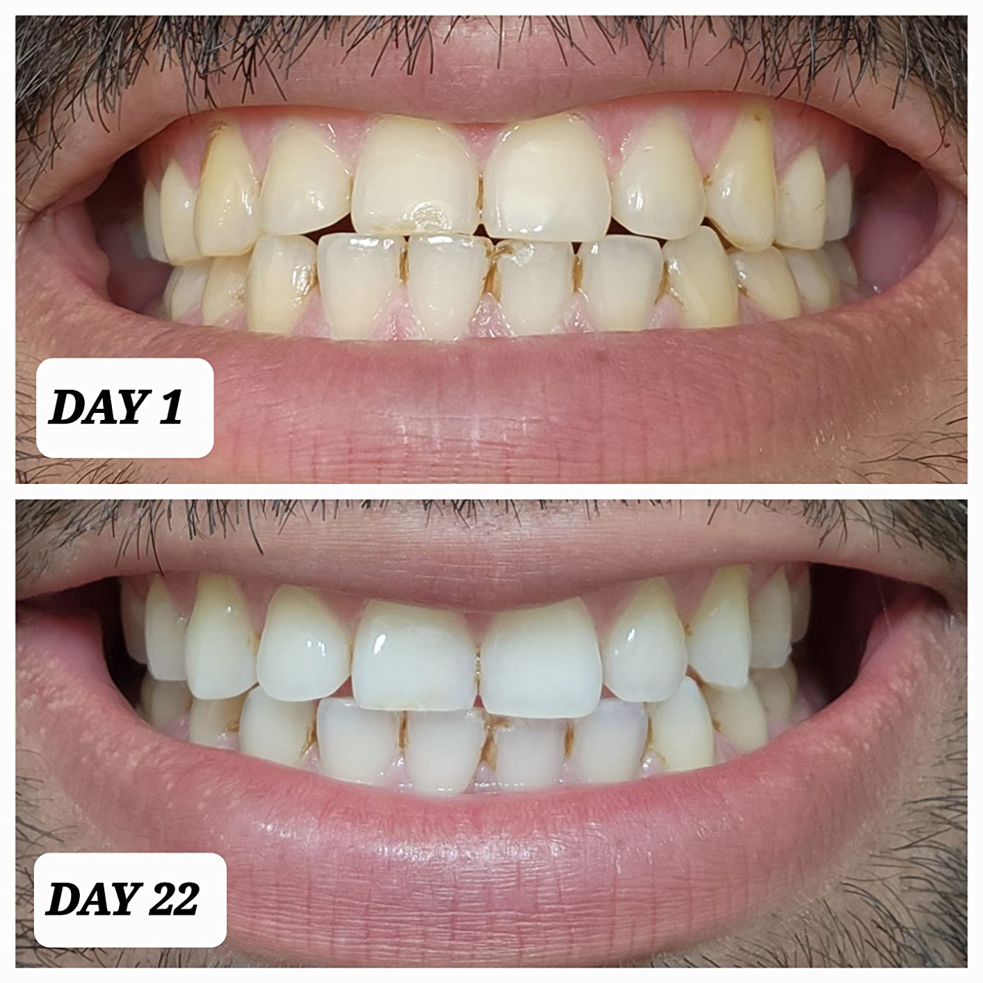 Crest 3D Whitestrips Professional Effects Teeth Whitening Kit, 22 Treatments (20 + 2 Bonus), 44 Strips customer photo 1