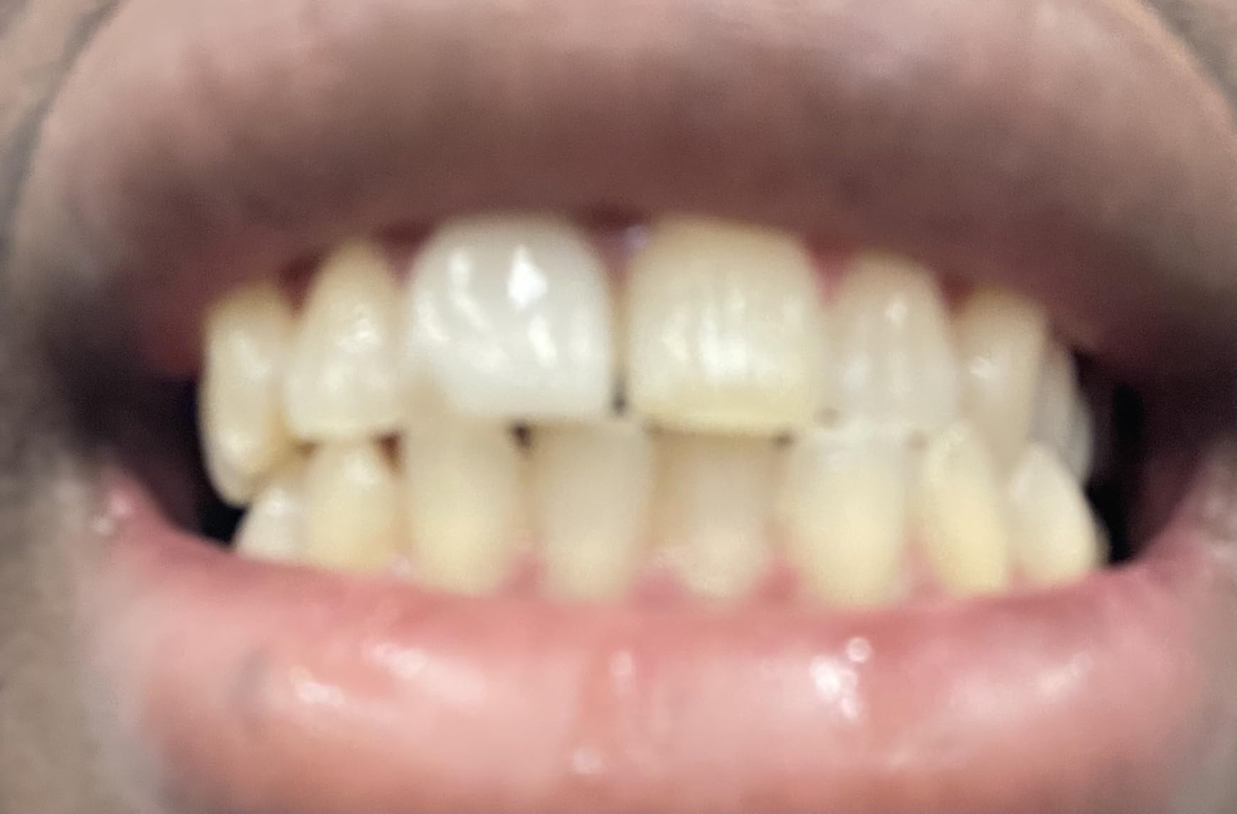 Opalescence Go 15% Prefilled Teeth Whitening Trays Kit, 15% Hydrogen Peroxide, 10 Treatments, Mint customer photo 1