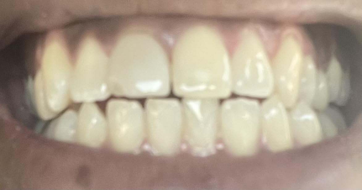 Opalescence Go 15% Prefilled Teeth Whitening Trays Kit, 15% Hydrogen Peroxide, 10 Treatments, Mint customer photo 2