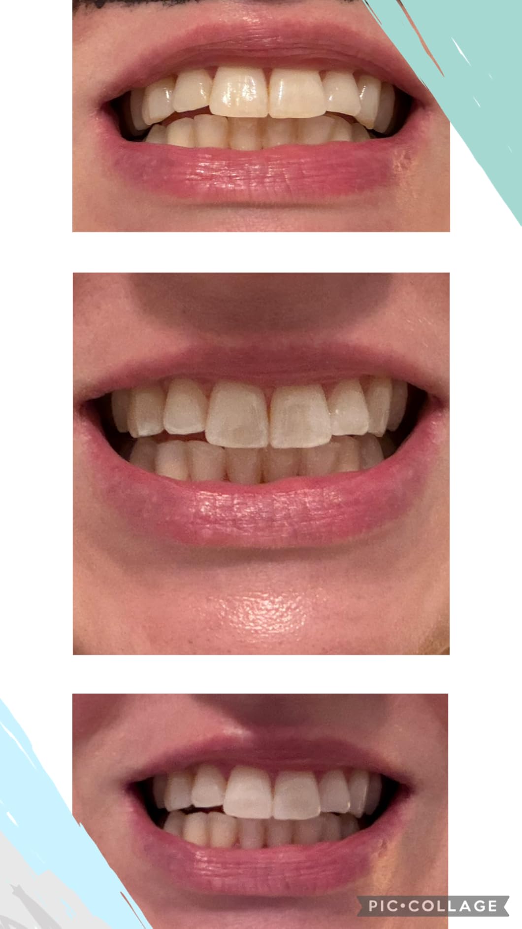 Auraglow Teeth Whitening Kit, LED Accelerator Light, 35% Carbamide Peroxide Gel, 20+ Treatments customer photo 1