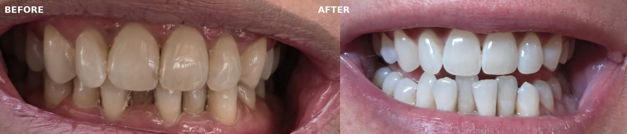 Auraglow Teeth Whitening Kit, LED Accelerator Light, 35% Carbamide Peroxide Gel, 20+ Treatments customer photo 2