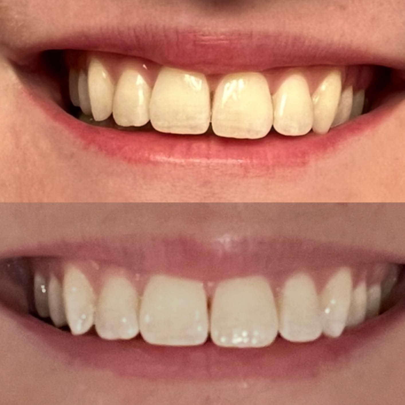 iSmile Teeth Whitening Kit - LED Light, 35% Carbamide Peroxide, (3) 3ml Gel Syringes, Remineralization Gel, Tray customer photo 2