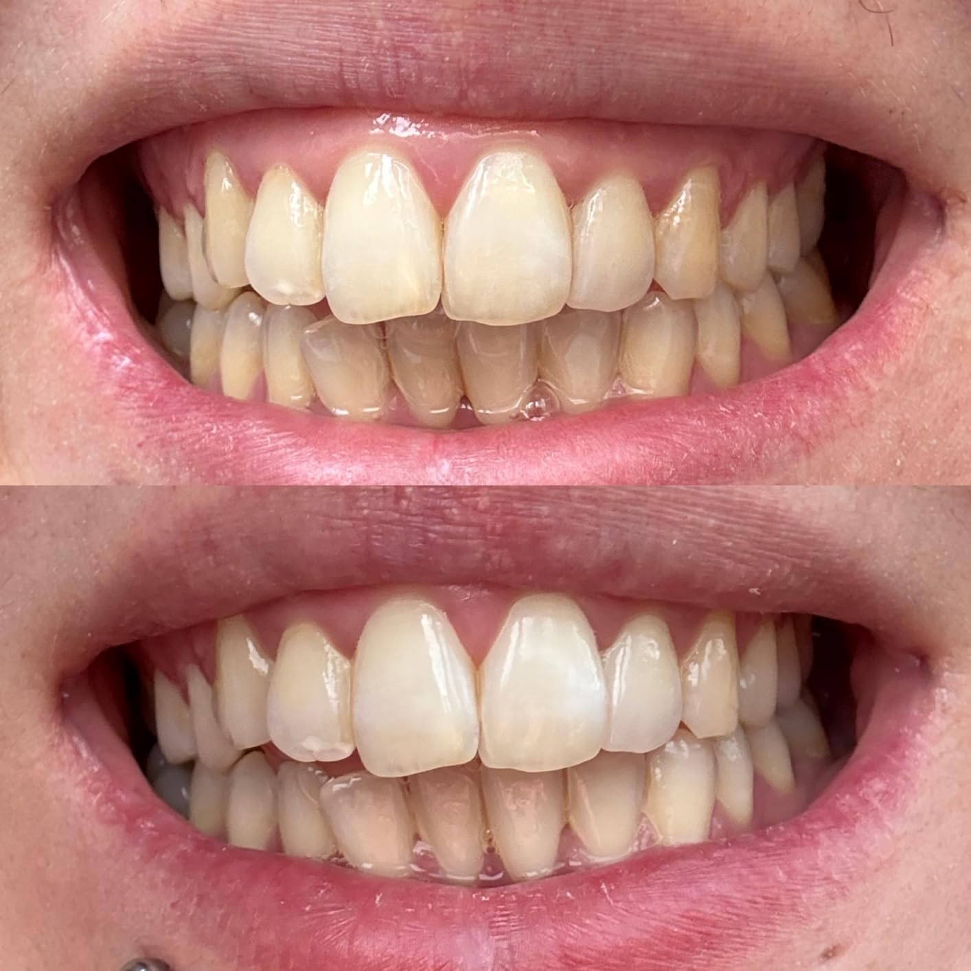 Crest 3D Whitestrips Sensitive White Teeth Whitening Kit, 18 Treatments, 36 Strips customer photo 2