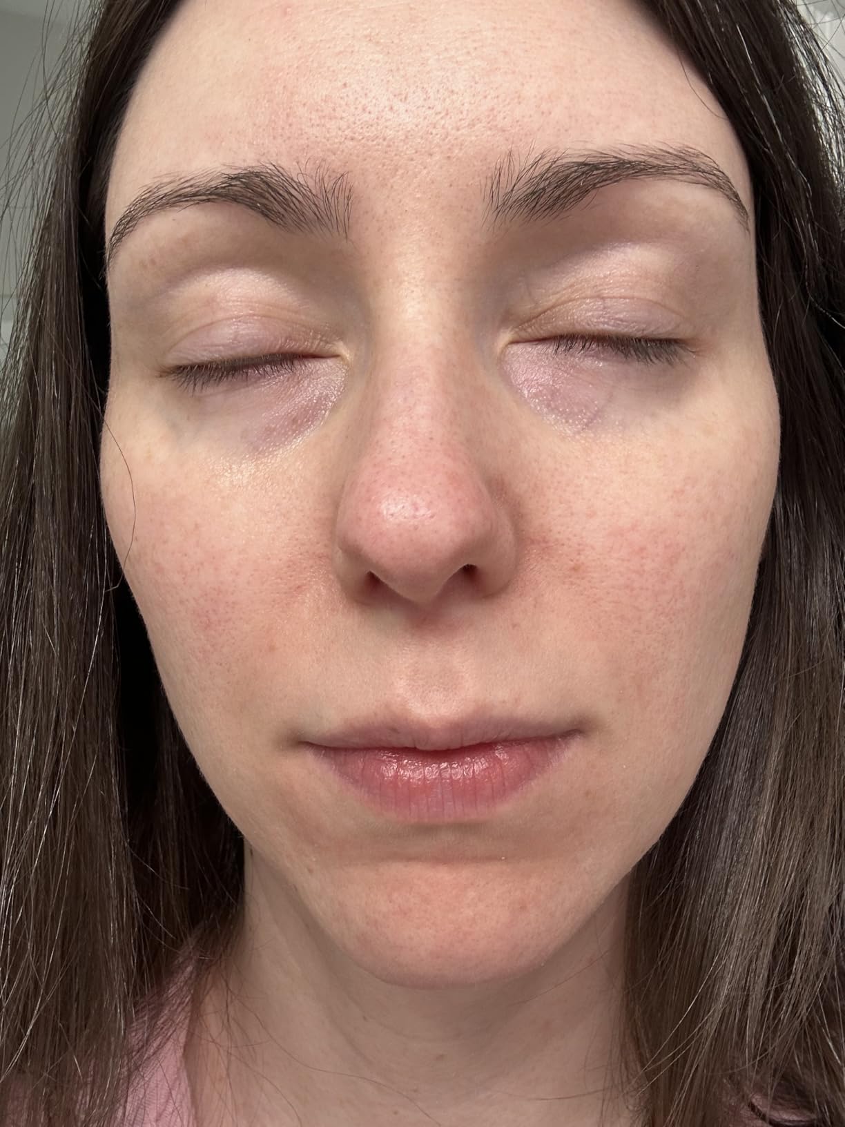Anua Azelaic Acid 10 Hyaluron Redness Soothing Serum, Facial Serum for Blemish-Prone & Oily-Prone Skin, Lightweight & Hydrating Blemish Care, Hyaluronic Acid, Korean Skincare, 1.01 fl oz. customer photo 1
