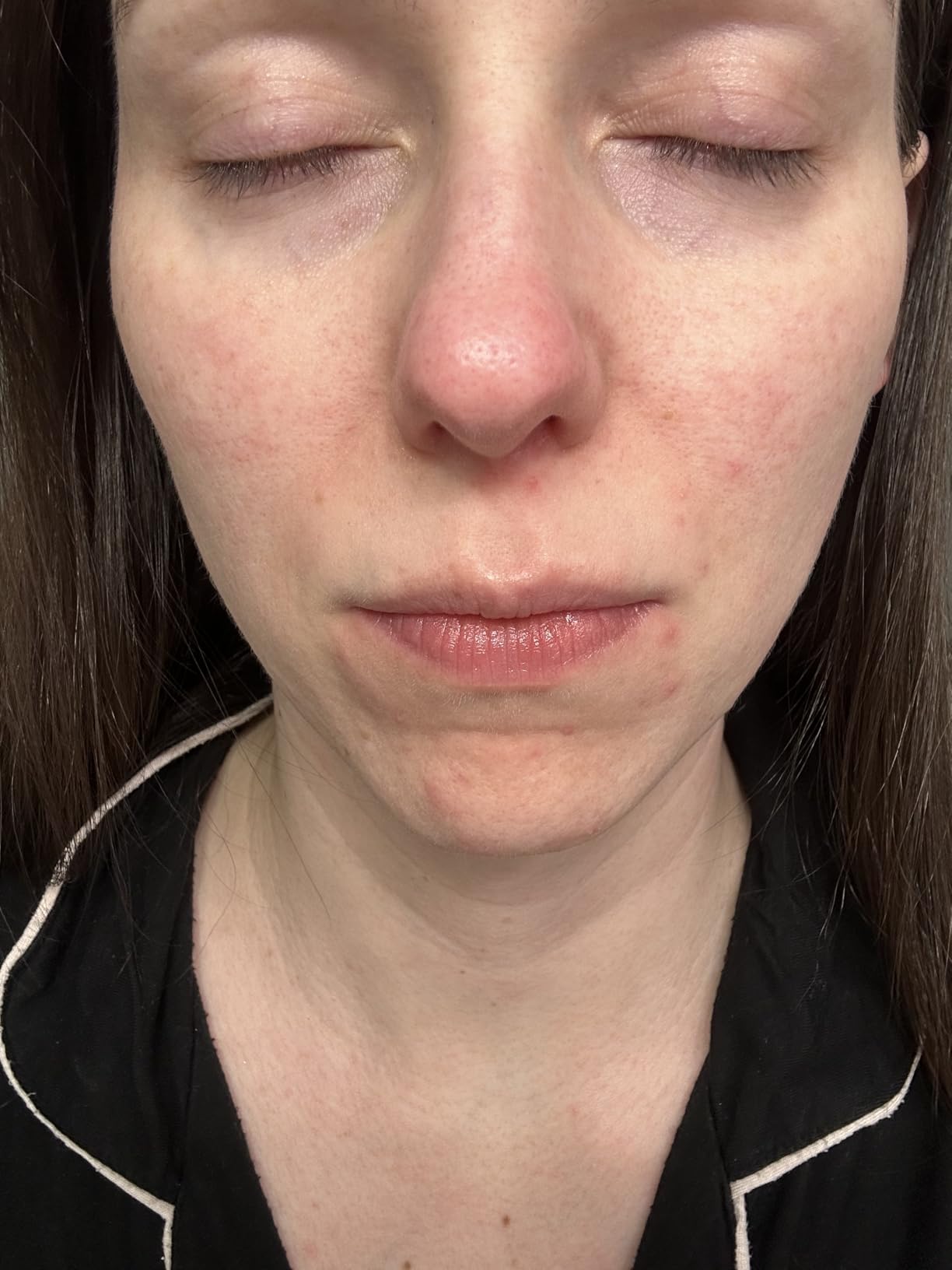 Anua Azelaic Acid 10 Hyaluron Redness Soothing Serum, Facial Serum for Blemish-Prone & Oily-Prone Skin, Lightweight & Hydrating Blemish Care, Hyaluronic Acid, Korean Skincare, 1.01 fl oz. customer photo 2