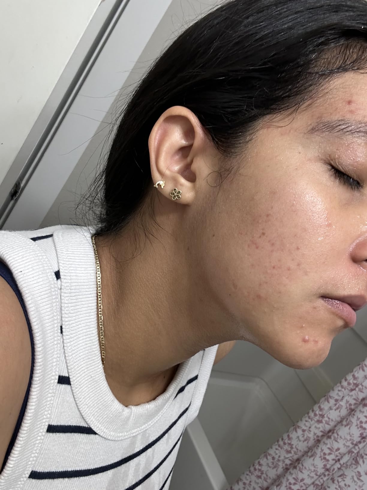 La Roche-Posay Effaclar Salicylic Acid Acne Treatment For Face, Mattifying Acne Gel Cream Spot Treatment for Blackheads, Whiteheads & Pores, Prevents New Pimples, Non-Greasy, Sensitive Skin Safe customer photo 1