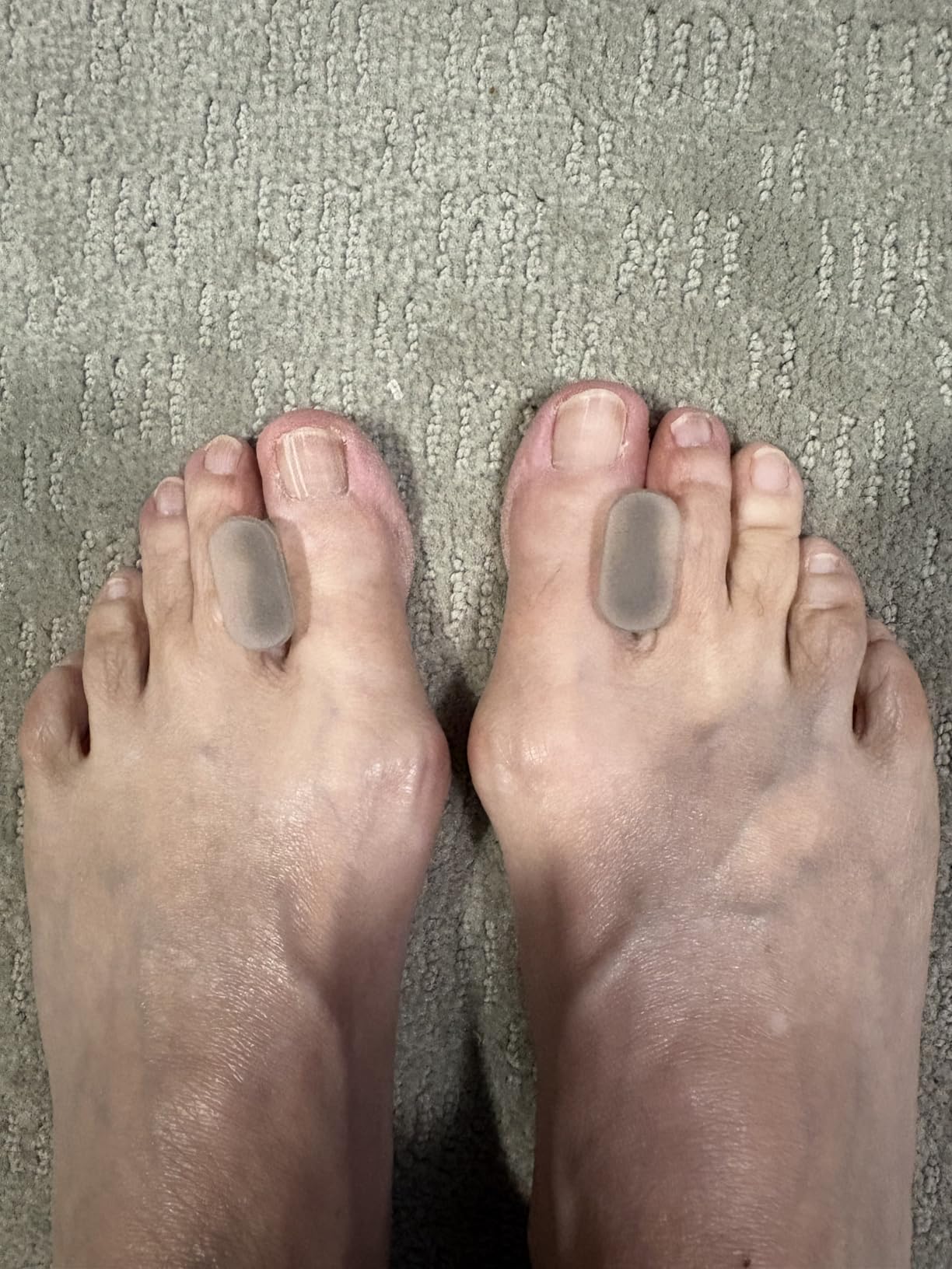 NatraCure Gel Toe Spacers 12 Pack - Helps with Bunions, Corns, Blisters, Rubbing & Overlapping Toes - Toe Separators for Women & Men to Correct Toes customer photo 2