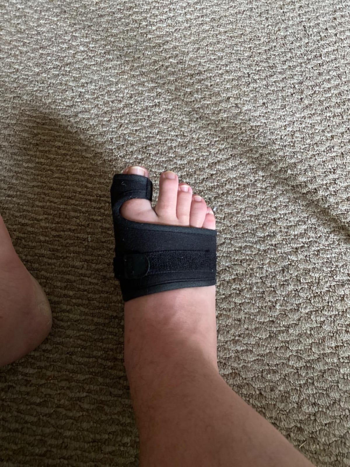 Vive Bunion Brace (Pair) - Big Toe Corrector Straightener with Splint | Hallux Valgus Pad, Joint Pain Relief, Alignment Treatment - Orthopedic Sleeve Foot Wrap Support for Men and Women (Black) customer photo 1