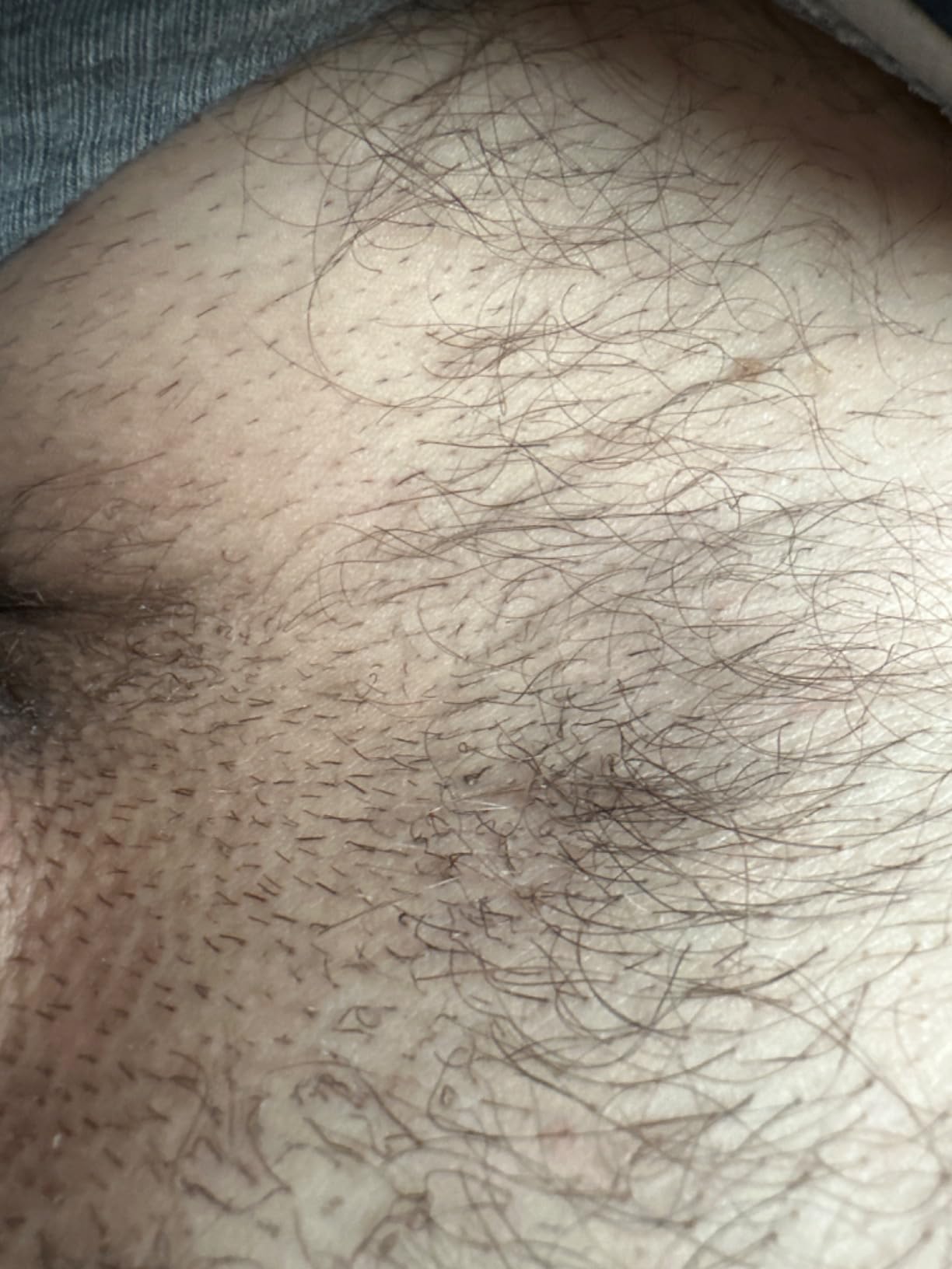 Braun Smart IPL, Skin i-Expert Pro 7, VOGUE's Best Hair Removal Device, IPL Hair Removal for Women and Men, Permanent Laser Hair Reduction At-Home, World's 1st Smart App, 3 Heads, IPL7243 customer photo 2